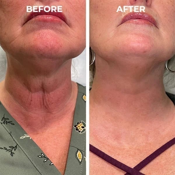 Last Day Promotion 49% OFF - đ„Botox Face Serum