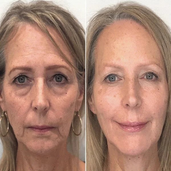 Last Day Promotion 49% OFF - 🔥Botox Face Serum