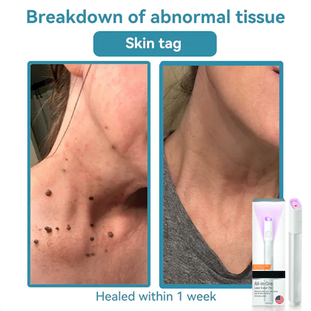✨All-in-One CO₂ Laser Eraser Pen | Removes Moles, Warts, Skin Flaws & Pigmentation