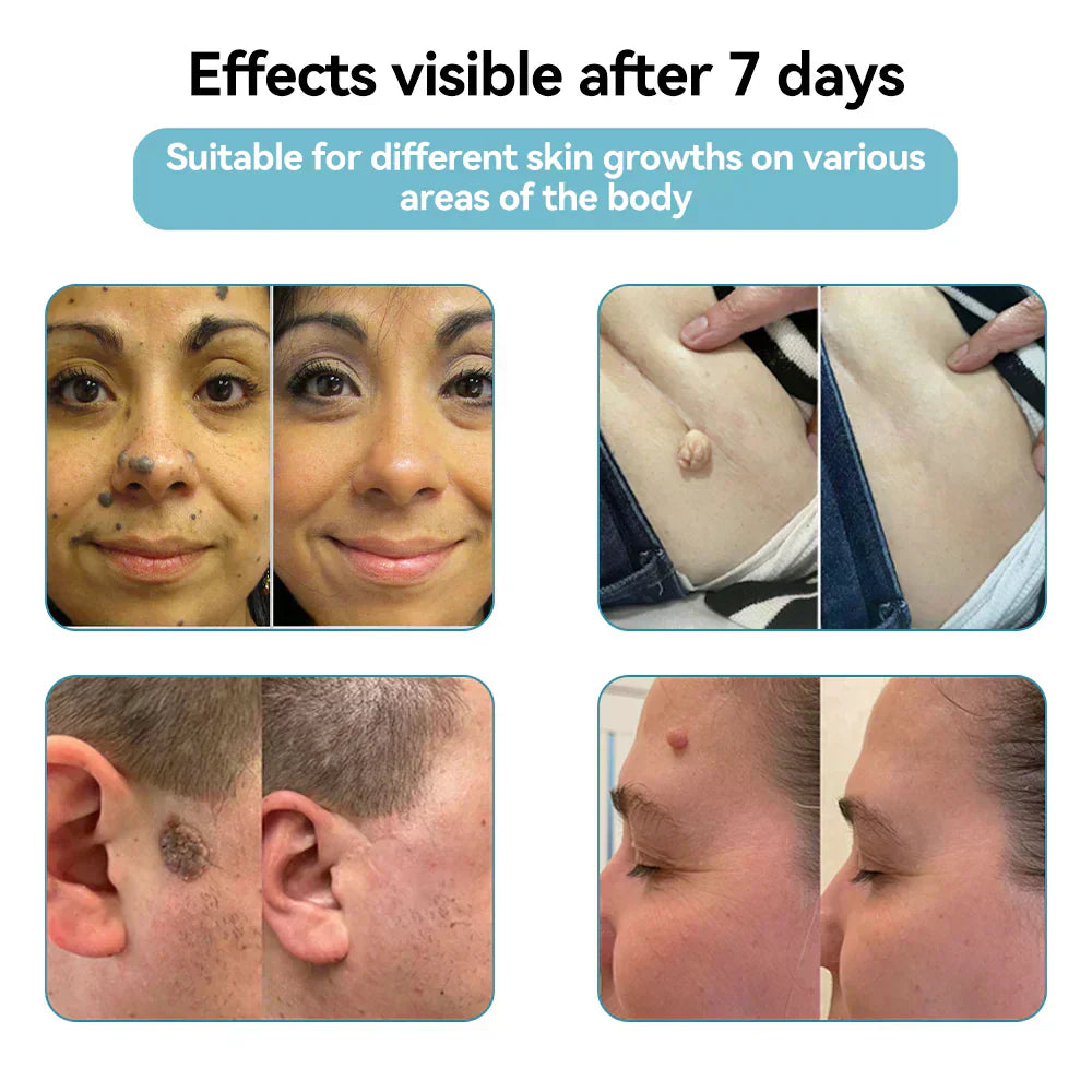 ✨All-in-One CO₂ Laser Eraser Pen | Removes Moles, Warts, Skin Flaws & Pigmentation